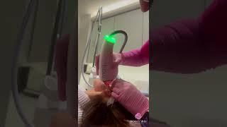 MOXI treatment #sciton #moxi
