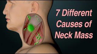 Adult Neck Mass: 7 Different Causes Based on Location