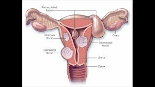 Mayo Clinic Minute - Nonsurgical treatment for uterine fibroids