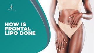 HOW IS FRONTAL LIPO DONE? OUR SURGEONS TAKE US THROUGH THE SURGERY PROCEDURE