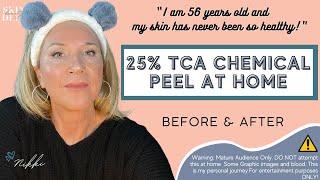 How-To Do a TCA Chemical Peel at Home