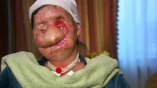 Woman Shows Face After Chimp Attack - GRAPHIC VIDEO