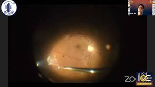 Diabetic TRD Surgery -Dr. David Xu