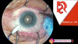 Mature cataract surgery