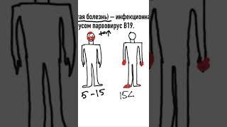 Пятая болезнь у взрослых. Подробнее на канале. #сыпь#подготовкакusmle#инфекционнаяэритема