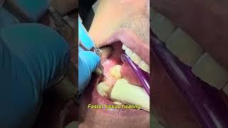 Why Er:YAG Laser Is a Game-Changer in Modern Dentistry! | Pain-Free, Precise & Fast Recovery