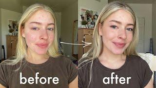 my everyday makeup routine with acne while on accutane!