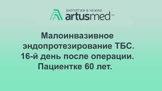 Походка пациента на 16-й день после операции по замене ТБС.