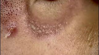 ACNE CLEANING - KINISH TV  #kinishacne #3