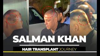 Salman Khan Hair Transplant Journey | Dadu Medical Centre