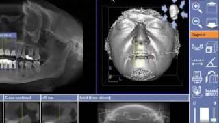 Dental Imaging Australia - Sirona Galileos 3D Cone Beam - Advanced Training Video - Surface Mode