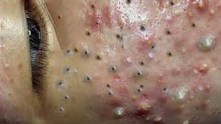 Big Cystic Acne Blackheads Extraction Blackheads & Milia, Whiteheads Removal Pimple Popping #