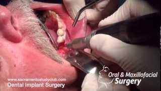 Dental Implant Surgery