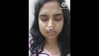 Wisdom Tooth Extraction surgery Recovery Time