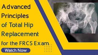 Advanced Principles of Total Hip Replacement for the FRCS Exam | Orthopaedic Academy