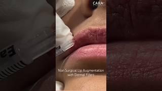 Lip Augmentation with Dermal Fillers at CARA Clinic Mumbai #lipfillers