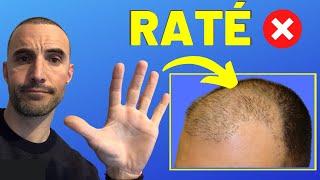 GREFFE DE CHEVEUX : LES 5 RAISONS POUR LESQUELLES ÇA RATE ! 🪓