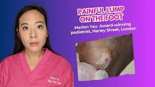 What Is This Painful Lump on the Foot? Expert Removal Explained!