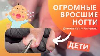 ОГРОМНЫЕ ДЕТСКИЕ ВРОСШИЕ НОГТИ. Динамика по лечению. ДО и ПОСЛЕ.