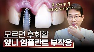 임플란트 달인이 알려주는 앞니 임플란트의 모든 것‼️