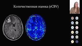 Нейропротокол в онкологии.  Основа-перфузия.