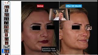 Closed Rhinoplasty: Before & After | Geschlossene Nasenkorrektur: Vorher & Nachher 