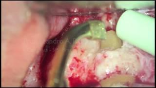 Endodontic MicroSurgery