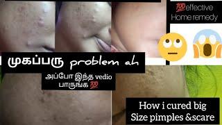 how i clear my pimples in 7days||effective home remedy ||cure pimple &scars||truth 