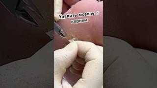 Целый процесс смотрите в разделе видео на моем канале #мозолька #мозоли #подологмосква