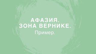 ИНСУЛЬТ. СЕНСОРНАЯ АФАЗИЯ (зона Вернике). Обследование пациента/Fluent aphasia