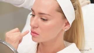 Увеличение губ Контурная пластика Juvederm