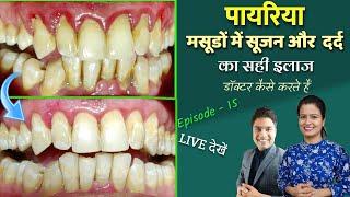 pyria ka ilaj in hindi | pyria kya hota hai | dental pyria treatment दांतों की सफाई Episode – 15