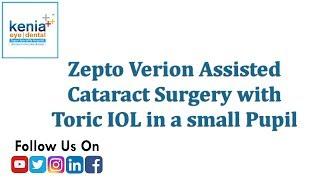 Zepto Verion Assisted Cataract  Surgery with Toric IOL in a small Pupil