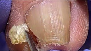 What A Big Nail! The Nails Are Crazily Embedded In The Root Of The Nail【Dr. Liu's Pedicur】