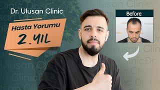 DANIŞANIMIZIN SAÇ EKİMİ SONRASI 2.YIL SONUCU VE RÖPORTAJI 