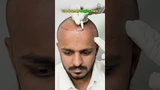Amazing Hair Transplant Surgery | Latest Fue Technique #shorts #viral #hair transplant