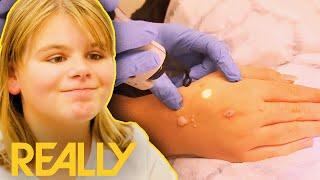 Girl Has 40 Warts Removed So She Can Make “New Friends” | The Bad Skin Clinic