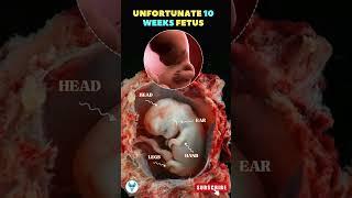 Understanding Fetal Development : A Look at the 10 Week Fetus #shorts #pregnancy #women