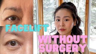 Natural Facelift Without Surgery! (all about non-surgical aesthetics treatments)