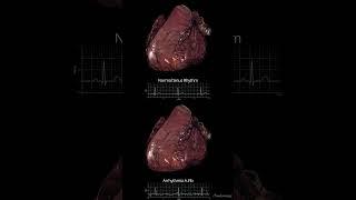 Atrial Fibrillation (AF)