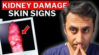 Doctor Explains 7 Skin Signs of Chronic Kidney Disease (CKD) - Never Ignore These Symptoms