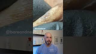 Ingrown hair frenzy! #ingrownhair #dermreacts #doctorreacts