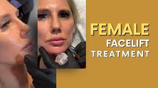 NATURAL LIQUID FEMALE FACELIFT WITH RHA FILLERS | Dr. Jason Emer