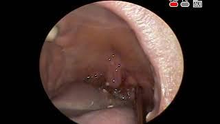 ПРОМЫВАНИЕ  #МИНДАЛИН #ПРОБКИ STONE REMOVAL TONSIL LAVAGE ХРОНИЧЕСКИЙ #ТОНЗИЛЛИТ ЛОР ВРАЧ