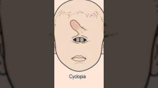 Cyclopia: The Terrifying Truth About One-Eyed Newborns #shorts