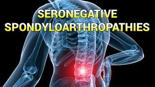 Seronegative Spondyloarthropathies (updated 2023) - CRASH! Medical Review Series