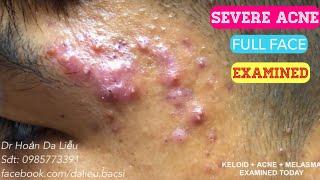 Mụn trứng cá mặt cực nặng|Dermatologist,pimples, whitehead blackhead,anti acne,pustule acne examined