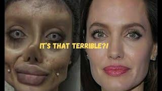 Famous Celebrities Unrecognizable After Plastic Surgery Gone Wrong | Then and Now 2024 #video