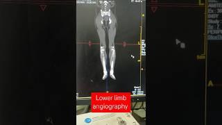 Lower limb angiography | peripheral angiography #angiography #radiology @hemantkushwah3453
