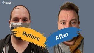 Hair Transplant Before and After - Month by Month results Elithair